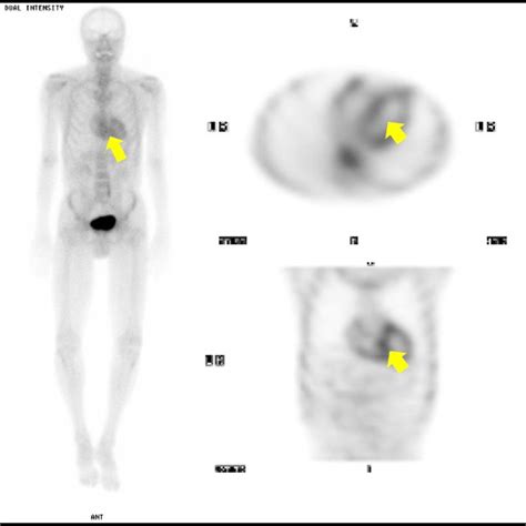 Delayed Technetium M Pyrophosphate Scintigraphy Showing Increased