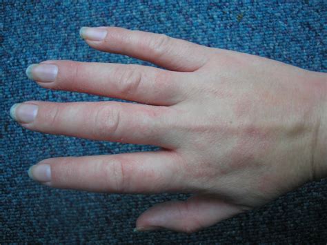 Fingertips Eczema Pictures Photos