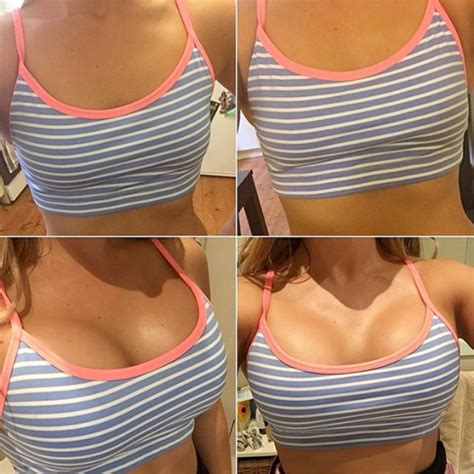 Collection 96 Pictures Breast Augmentation Surgery Pictures Excellent