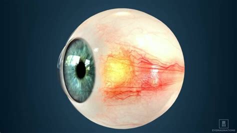 Pinguecula And Pterygium Eye Disease Symptoms And Treatment