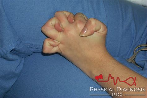 Ehlers-Danlos Syndrome - Physical Diagnosis PDX