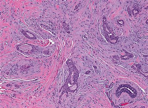 Pathology Outlines Low Grade Adenosquamous