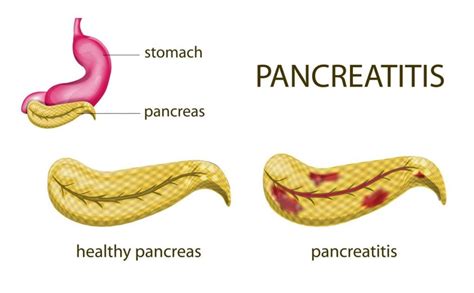 What is Fascioliasis? - Facty Health