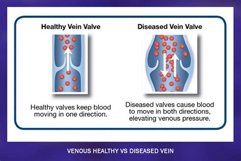 Venous Reflux Disease Treatment | Vein Clinic of Northeast Nebraska - Norfolk, NE