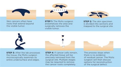 Mohs Surgery Apex Dermatology And Skin Surgery