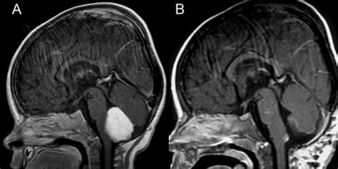 Federated Learning Project Will Train AI to Detect Brain Tumors Early | Engineering.com