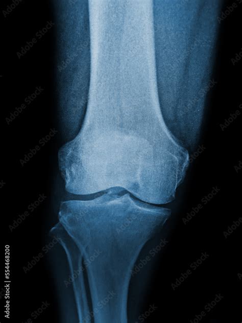 x ray image of knee Stock Photo | Adobe Stock