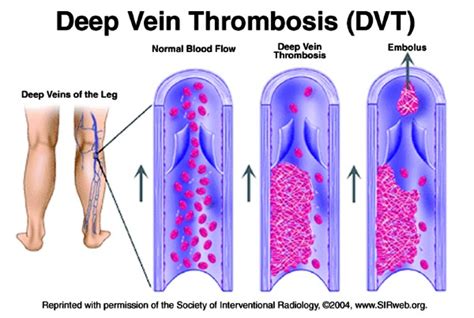 Deep Venous Thrombosis Dvt Cardiovascular Disorders Msd 50 Off