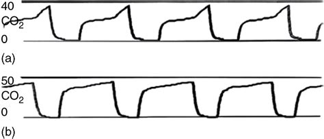 Capnography During Anesthesia Chapter 6 Capnography