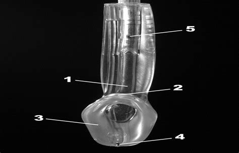 Fiberoptic Intubation Through An I Gel Supraglottic Airway I