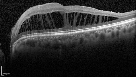 Optic Disk Pits And Optic Disk Pit Maculopathy A Review Survey Of