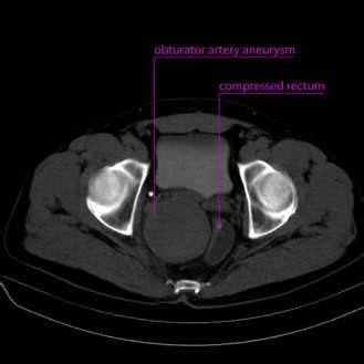 Obturator artery aneurysm on CT picture. | Download Scientific Diagram