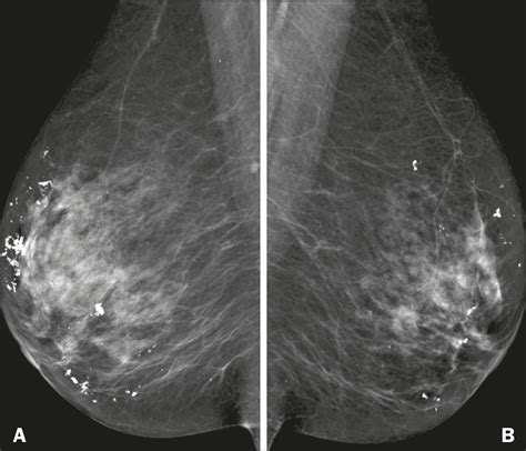 Scielo Brasil Radiological Findings Of Breast Involvement In Benign