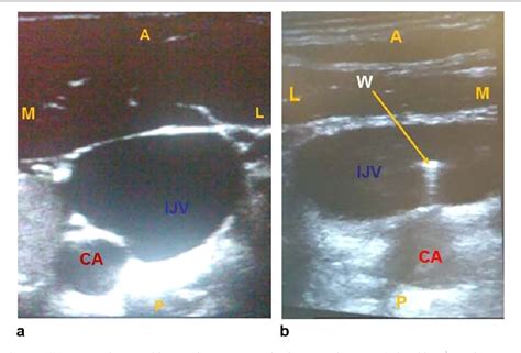 Figure 1 From Long Axis View For Ultrasound Guided Central Venous Catheter Placement Via The