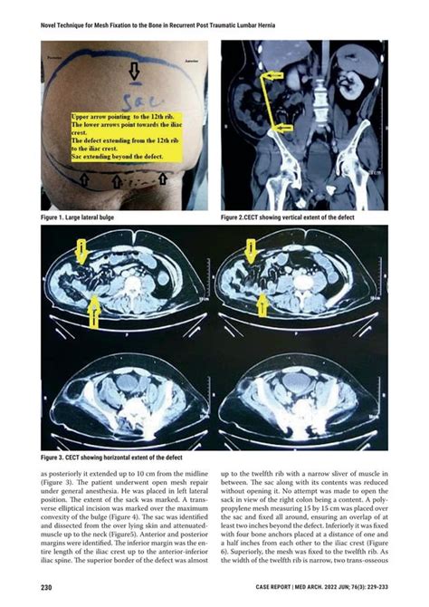 Novel Technique For Mesh Fixation To The Bone In Recurrent Post