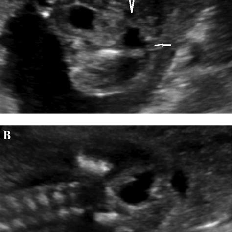 Ultrasound images of amniotic band syndrome and a lumbosacral ...