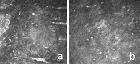 Acanthamoeba Keratitis Corneal Microcysts Cystic Stages Of Life Cycle Download Scientific