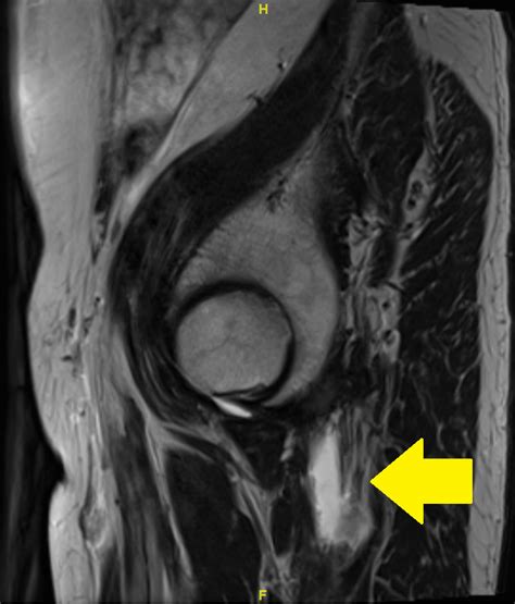 Mri Of The Pelvis With T2 Turbo Spin Echo Tse Images Sagittal View