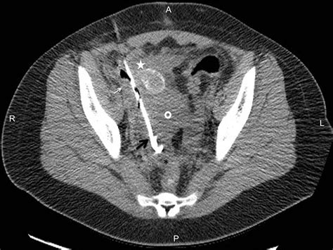 Hydrodissection Assisted Percutaneous Drainage Of Deep Pelvic Abscess