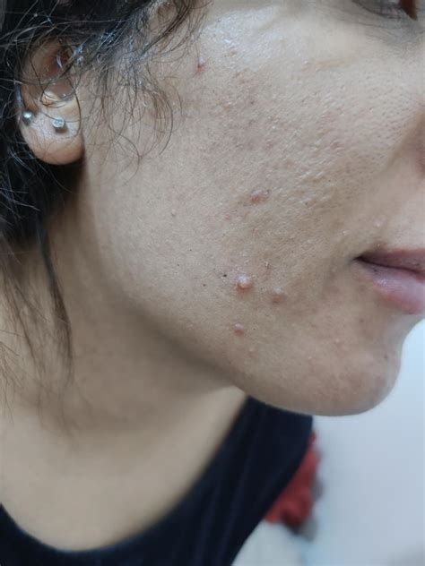 Estee Lauder Foundation Causing Skin Issues - Xolvie