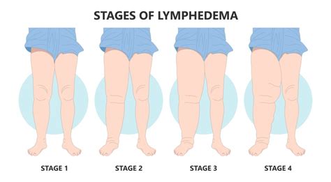 Lipedema or Just Fat Legs? Crucial Things to Know - Salameh Plastic ...