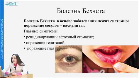 Хронический рецидивирующий афтозный стоматит - YouTube