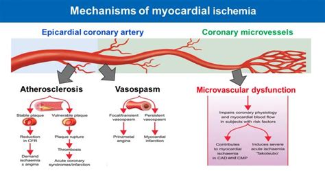 Microvascular Angina Is Import Image Eurekalert Science News Releases