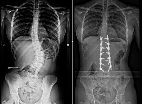 Escoliose idiopática Tratamento ortopédico Dr Barsotti