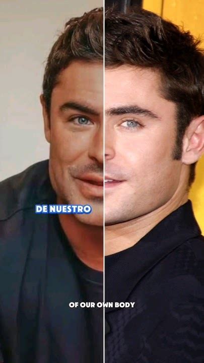 Zac Efron ¿qué Le Pasó En Su Rostro Dermatologo Masculinizacion