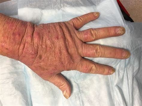 DermDx Thin Erythematous Plaques On Upper Arms And Hands Dermatology