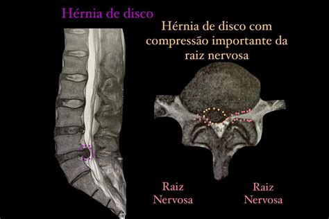 Cirurgia de hérnia de disco realizado no HRT permite alta de paciente