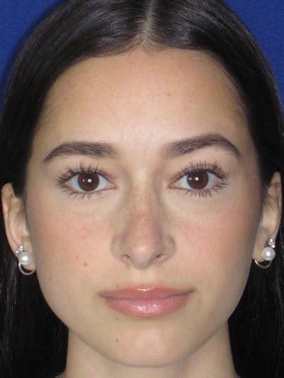 Rhinoplasty Gallery | Dr. Anthony Corrado