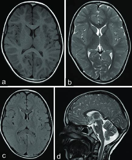 Magnetic Resonance Imaging Of The Brain Axial Sections A T1w B T2w