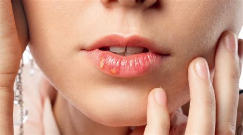 Herpes Oral Cum Se Trateaz N Perioada Sarcinii