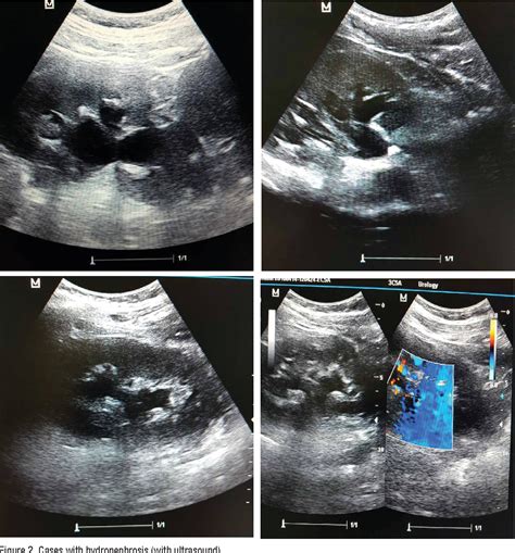 Mild Hydronephrosis Ultrasound