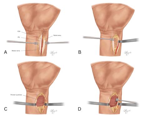 The Trans FCR And Henry Approaches Begin With An Incision Over The