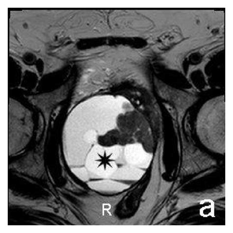 Mri Axial A And Sagittal B T Weighted Images Axial Precontrast