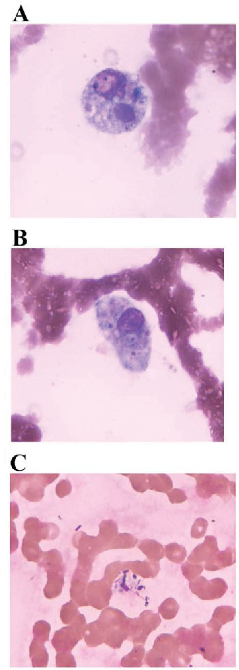 Figure 1 From Hemophagocytic Lymphohistiocytosis In A Patient With