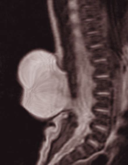 Figure Spinal Dysraphism Image Courtesy S Bhimji Md Statpearls