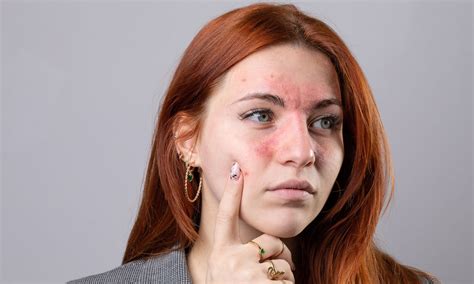 Understanding And Managing Rosacea Sublime Medispa