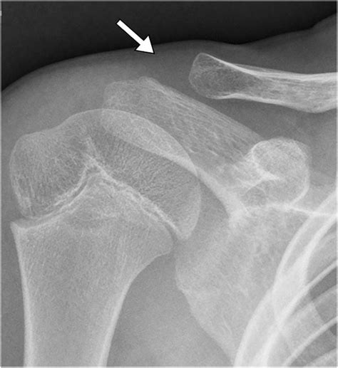 Apparent Acromioclavicular Joint Widening In A Year Old Boy