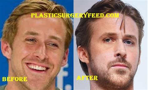 Ryan Gosling Plastic Surgery - Plastic Surgery Feed