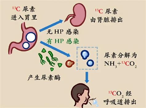 幽门螺杆菌检测方法大揭秘是呼气试验准还是胃镜准确 知乎