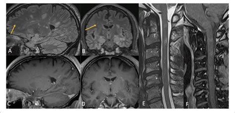 Case 4 Contrast MR Brain Demonstrating Numerous T2 Hyperintense