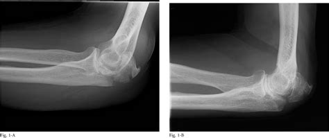 Figure From Nonoperative Management Of Displaced Olecranon Fractures