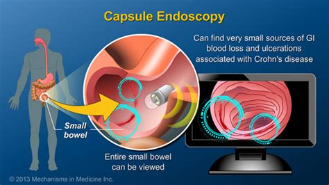 Slide Show Diagnosing Ibd