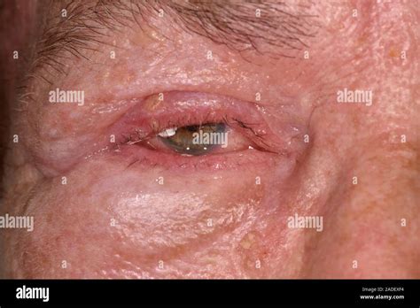 MODEL RELEASED Shingles Rash Affecting Facial Nerve Shingles Rash