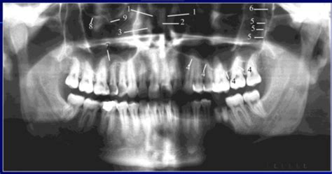 Panoramic Radiology Flashcards Quizlet