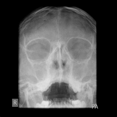 Chronische Sinusitis Pacs