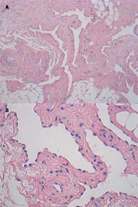 Lymphangioma Histology